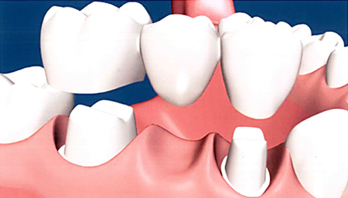 Dental Bridges in Merced, CA