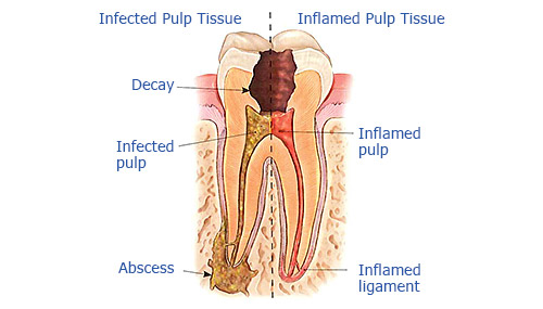 Root Canals in Merced, CA