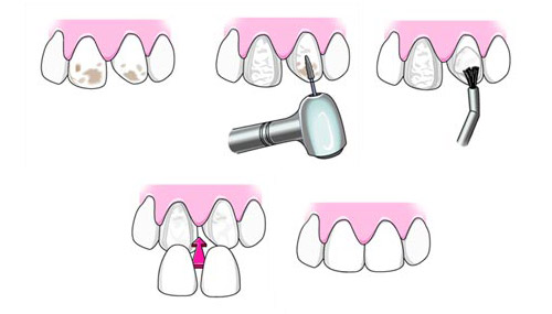 Veneers in Merced, CA