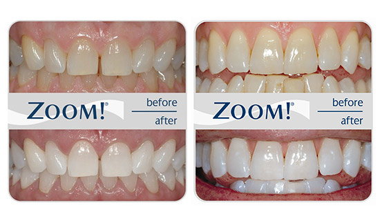 Zoom Teeth Whitening